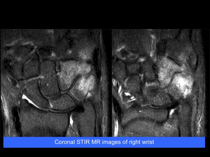Figure 4 for case Trevors Disease (Dysplasia Ephiphysealis Hemimelica)